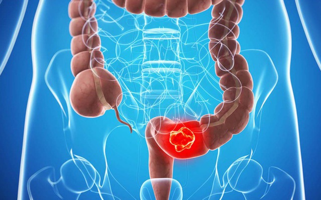 Nam thanh niên 25 tuổi bị đau bụng, tưởng rối loạn tiêu hoá: Kiểm tra phát hiện ung thư trực tràng giai đoạn muộn - những TÍN HIỆU bị BỎ QUÊN - Ảnh 2. Nam thanh niên 25 tuổi bị đau bụng, tưởng rối loạn tiêu hoá: Kiểm tra phát hiện ung thư trực tràng giai đoạn muộn - những TÍN HIỆU bị BỎ QUÊN - Ảnh 2.