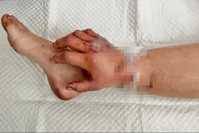 Để mẹ trọn vẹn vòng tay ôm con: bác sĩ ghép tạm bàn tay đứt lìa vào chân thai phụ- Ảnh 3.