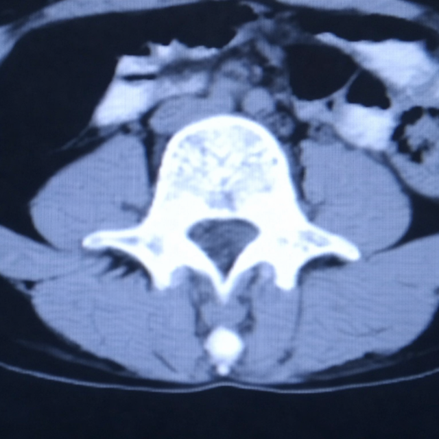 Nam sinh vi&ecirc;n năm 2 qua đời sau chẩn đo&aacute;n ung thư đại tr&agrave;ng, thủ phạm l&agrave; 2 th&oacute;i quen nhiều người lặp lại h&agrave;ng ng&agrave;y- Ảnh 1.
