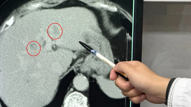 Người phụ nữ 60 tuổi mắc ung thư gan, một nửa gan là mỡ vì ngày nào cũng ăn 2 món "vạn người mê"- Ảnh 1. Người phụ nữ 60 tuổi mắc ung thư gan, một nửa gan là mỡ vì ngày nào cũng ăn 2 món "vạn người mê"- Ảnh 1.