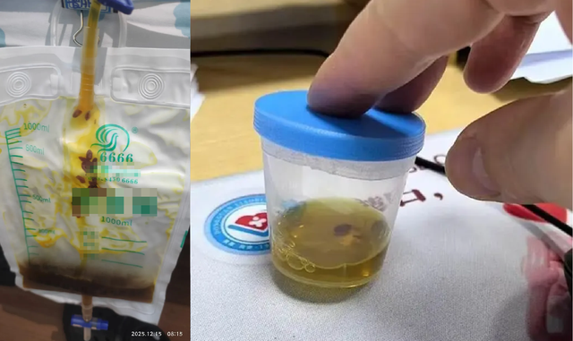 Bác sĩ rùng mình phát hiện thứ đáng sợ trong ống mật của người đàn ông 40 tuổi sau khi bị đau bụng- Ảnh 2. Bác sĩ rùng mình phát hiện thứ đáng sợ trong ống mật của người đàn ông 40 tuổi sau khi bị đau bụng- Ảnh 2.