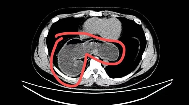 Chàng trai 28 tuổi một nửa dạ dày "tràn vào" lồng ngực vì ngày nào cũng dùng thức uống "vạn người mê"- Ảnh 1. Chàng trai 28 tuổi một nửa dạ dày "tràn vào" lồng ngực vì ngày nào cũng dùng thức uống "vạn người mê"- Ảnh 1.