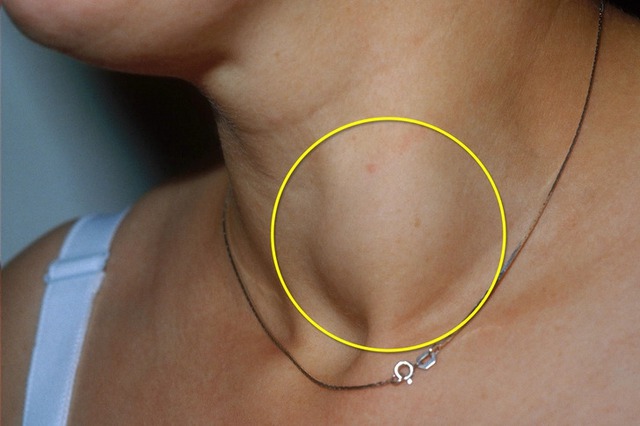 8 người một nhà cùng mắc ung thư tuyến giáp, bác sĩ nhắc nhở: Thấy 5 thay đổi này, e rằng "tế bào ung thư” đã lớn- Ảnh 2. 8 người một nhà cùng mắc ung thư tuyến giáp, bác sĩ nhắc nhở: Thấy 5 thay đổi này, e rằng "tế bào ung thư” đã lớn- Ảnh 2.