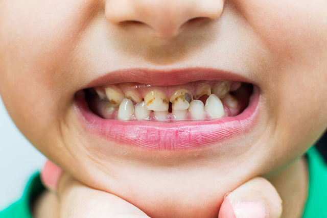 B&eacute; trai 10 tuổi xuất huyết n&atilde;o nghi&ecirc;m trọng sau khi tự nhổ răng s&acirc;u, b&aacute;c sĩ cảnh b&aacute;o cha mẹ - Ảnh 1.