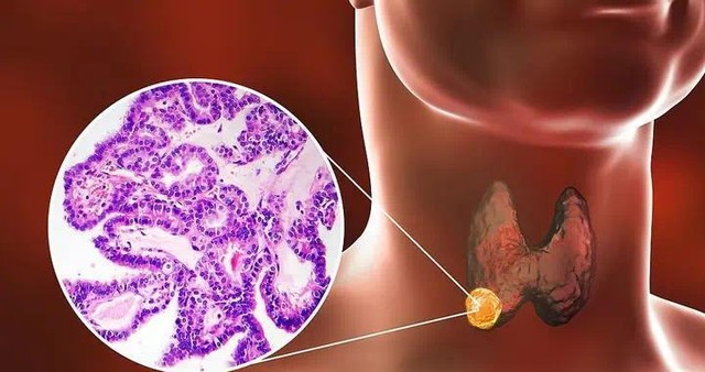 Nữ sinh 15 tuổi mắc ung thư tuyến giáp, phát hiện đã di căn hạch: Lời kể của gia đình về thói quen thức khuya khiến bác sĩ chú ý- Ảnh 3.