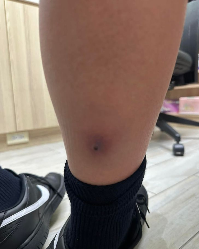 Tưởng chỉ l&agrave; c&uacute;m m&ugrave;a, b&eacute; trai 12 tuổi sốt trở lại: B&aacute;c sĩ v&eacute;n ống quần kiểm tra liền y&ecirc;u cầu cấp cứu khẩn cấp - Ảnh 1.