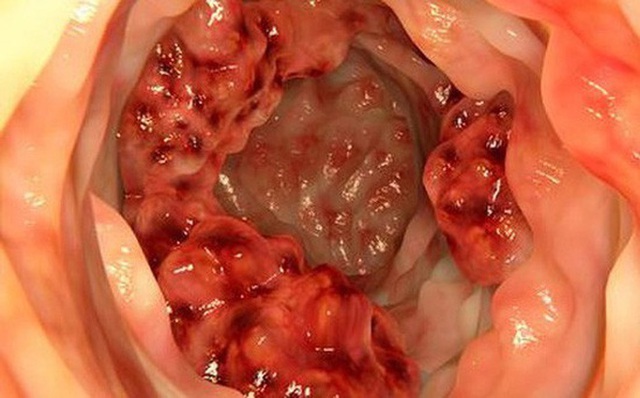 Sao phim "Ng&atilde; rẽ cuộc đời" qua đời ở tuổi 49 do ung thư: Bệnh đang trẻ h&oacute;a mức b&aacute;o động, giới chuy&ecirc;n m&ocirc;n gần đ&acirc;y cảnh b&aacute;o li&ecirc;n tục- Ảnh 2.