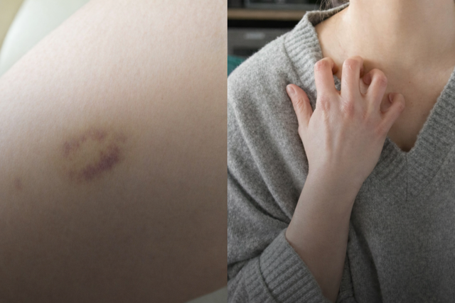 Ph&oacute; Gi&aacute;m đốc Bệnh viện Th&aacute;i Lan cảnh b&aacute;o 4 dấu hiệu tr&ecirc;n da l&agrave; "lời k&ecirc;u cứu" của gan, nhiều người bỏ qua rồi hối hận kh&ocirc;ng kịp- Ảnh 2.