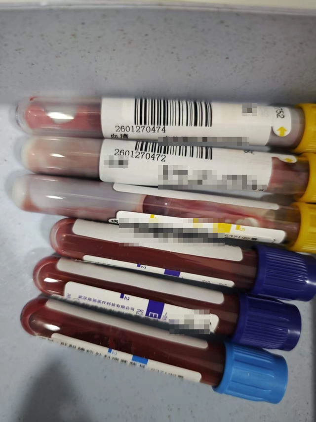 Nam sinh năm nhất "m&aacute;u trắng như sữa", mỡ m&aacute;u cao gấp 47 lần b&igrave;nh thường v&igrave; th&oacute;i quen ăn uống nhiều người mắc - Ảnh 1.