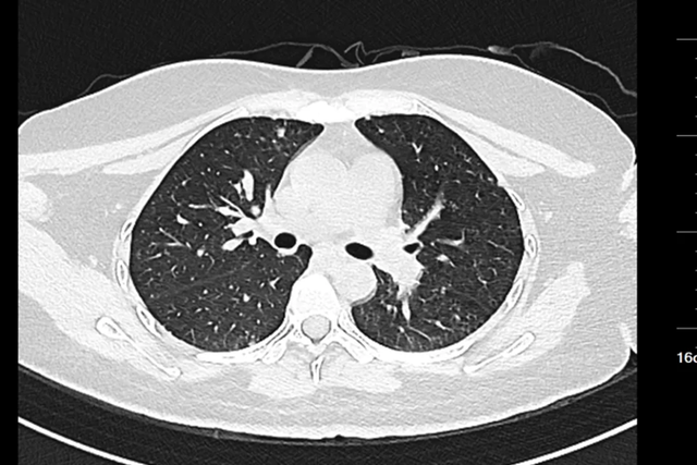 Nữ sinh 20 tuổi đau cổ, đi khám phát hiện ung thư dạ dày đã di căn toàn thân: Đừng bỏ qua dấu hiệu này - Ảnh 2.