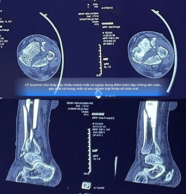Cứu th&agrave;nh c&ocirc;ng b&agrave;n ch&acirc;n g&atilde;y n&aacute;t biến chứng nặng do đắp thuốc thầy lang - Ảnh 1.