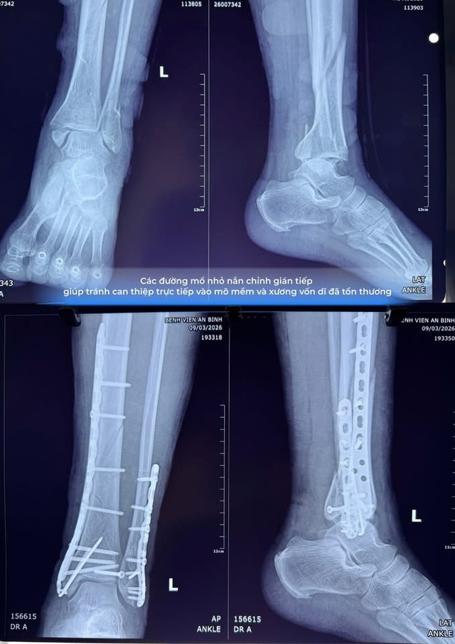Cứu th&agrave;nh c&ocirc;ng b&agrave;n ch&acirc;n g&atilde;y n&aacute;t biến chứng nặng do đắp thuốc thầy lang - Ảnh 3.