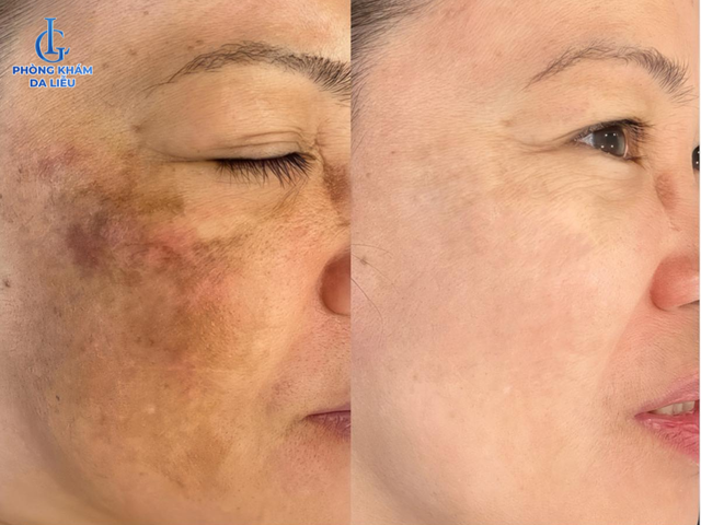 Ph&ograve;ng kh&aacute;m da liễu LG Clinic chi 10 triệu đ&ocirc; nhập c&ocirc;ng nghệ điều trị n&aacute;m - t&aacute;i tạo da h&agrave;ng đầu thế giới - Ảnh 3.