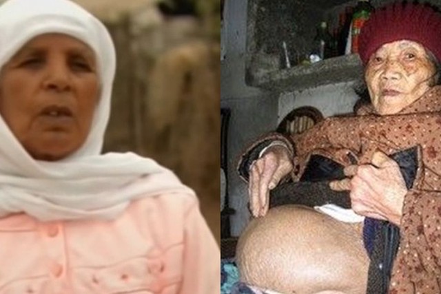 Người phụ nữ mang thai suốt 46 năm m&agrave; kh&ocirc;ng hề hay biết cho đến khi ngo&agrave;i 70 tuổi - Ảnh 1.