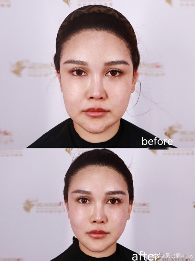 C&ocirc; g&aacute;i cao 1m80 bị &eacute;p dao k&eacute;o từ năm 14 tuổi, hơn 300 lần phẫu thuật: Gương mặt hiện tại thế n&agrave;o? - Ảnh 4.