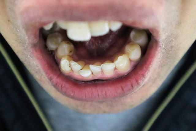 Vẫn bị h&ocirc;i miệng d&ugrave; đ&aacute;nh răng bao nhi&ecirc;u lần đi nữa, b&aacute;c sĩ tiết lộ "thủ phạm thực sự": Nhiều người ho ra "hạt gạo" c&oacute; m&ugrave;i h&ocirc;i- Ảnh 1.