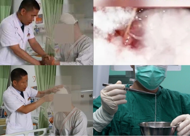 "Sốc nặng" với ch&agrave;ng trai 24 tuổi nhưng 13 năm bị sinh vật sống "gặm nhấm" n&atilde;o, g&acirc;y t&agrave;n tật: Gắp ra ngo&agrave;i c&ograve;n ngoe nguẩy- Ảnh 2.