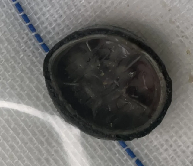 B&eacute; g&aacute;i 6 tuổi chảy m&aacute;u v&ugrave;ng k&iacute;n suốt 4 năm, đi kh&aacute;m mới ph&aacute;t hiện thứ &ldquo;kh&ocirc;ng ai ngờ&rdquo; b&ecirc;n trong- Ảnh 1.