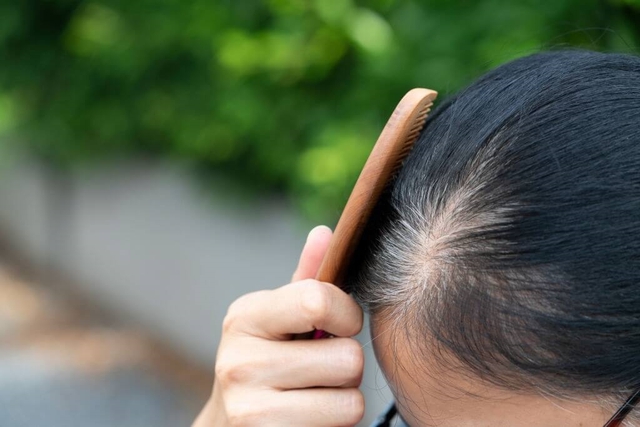 Người trẻ t&oacute;c bạc sớm: B&aacute;c sĩ chỉ ra 3 dưỡng chất hay bị thiếu hụt, &iacute;t người để &yacute; đến- Ảnh 1.