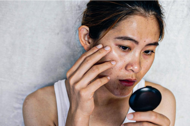 Nh&igrave;n mặt đo&aacute;n bệnh gan, b&aacute;c sĩ: Người bị bệnh gan c&oacute; 5 điểm bất thường tr&ecirc;n khu&ocirc;n mặt - Ảnh 3.