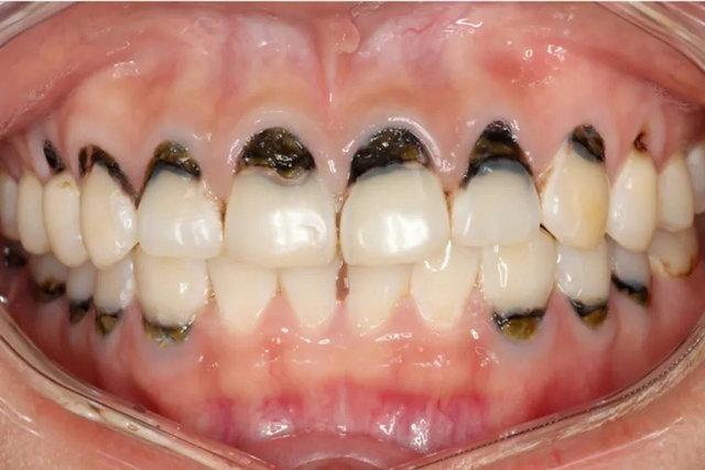 Người phụ nữ 30 tuổi cả h&agrave;m ch&acirc;n răng đen s&igrave;, m&ugrave;i h&ocirc;i nồng nặc v&igrave; 1 loại nước vạn người m&ecirc;- Ảnh 2.
