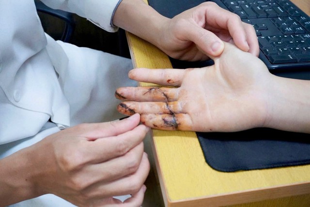 “Cuộc chạy đua” 10 giờ giữ lại 3 ngón tay gần đứt lìa cho nam thanh niên trong ngày đầu đi làm - Ảnh 1.