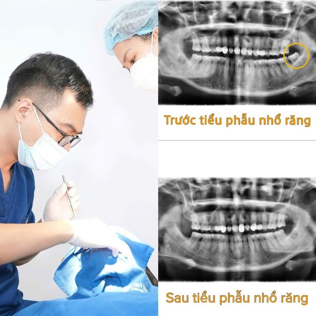 T&acirc;m sự của một b&aacute;c sĩ chuy&ecirc;n ng&agrave;nh Răng H&agrave;m Mặt: "Điều t&ocirc;i muốn lấy đi kh&ocirc;ng chỉ l&agrave; chiếc răng kh&ocirc;n, m&agrave; l&agrave; nỗi sợ của bệnh nh&acirc;n"- Ảnh 3.