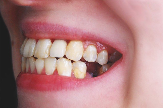 Vì sao nhiều người mất răng nhưng không chịu trồng?- Ảnh 1.