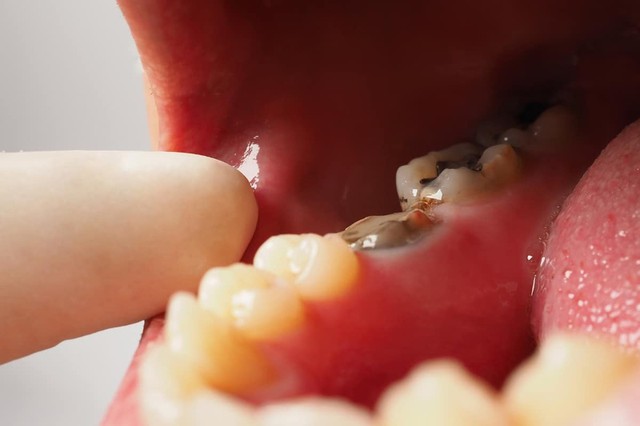 Vì sao nhiều người mất răng nhưng không chịu trồng?- Ảnh 2.