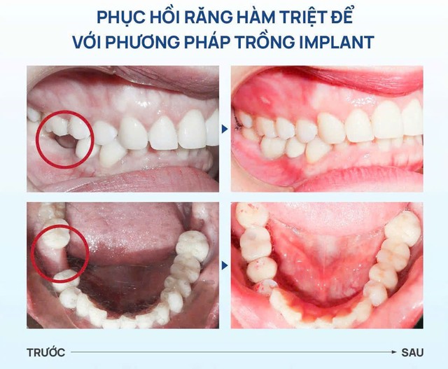 Vì sao nhiều người mất răng nhưng không chịu trồng?- Ảnh 4.