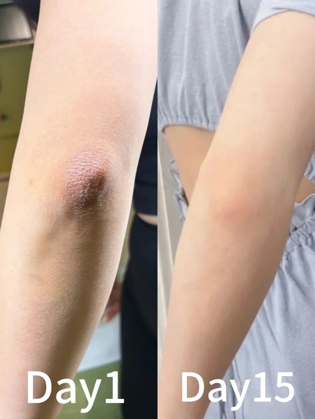 Thử “giải cứu” khuỷu tay thâm trong 1 tuần với 4 bước: Có một bước tôi khuyên không nên tùy tiện làm theo - Ảnh 1.