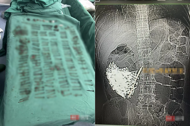 Phẫu thuật lấy ra hơn 1kg đinh sắt, đồng xu, ốc v&iacute;t trong dạ d&agrave;y một người đ&agrave;n &ocirc;ng - Ảnh 1.