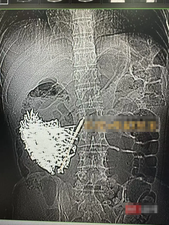 Phẫu thuật lấy ra hơn 1kg đinh sắt, đồng xu, ốc v&iacute;t trong dạ d&agrave;y một người đ&agrave;n &ocirc;ng - Ảnh 2.