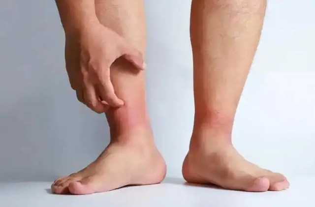 Ch&acirc;n sưng một b&ecirc;n, tuyệt đối đừng chủ quan: Cảnh b&aacute;o dấu hiệu cục m&aacute;u đ&ocirc;ng đang h&igrave;nh th&agrave;nh- Ảnh 1.