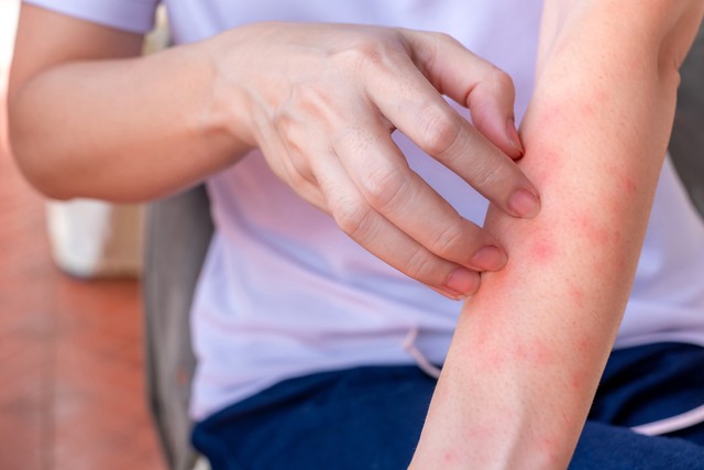 Nếu bạn c&oacute; hai v&ugrave;ng da bị ngứa dai dẳng tr&ecirc;n cơ thể, h&atilde;y cảnh gi&aacute;c v&igrave; đ&oacute; c&oacute; thể l&agrave; dấu hiệu của ung thư gan - Ảnh 1.