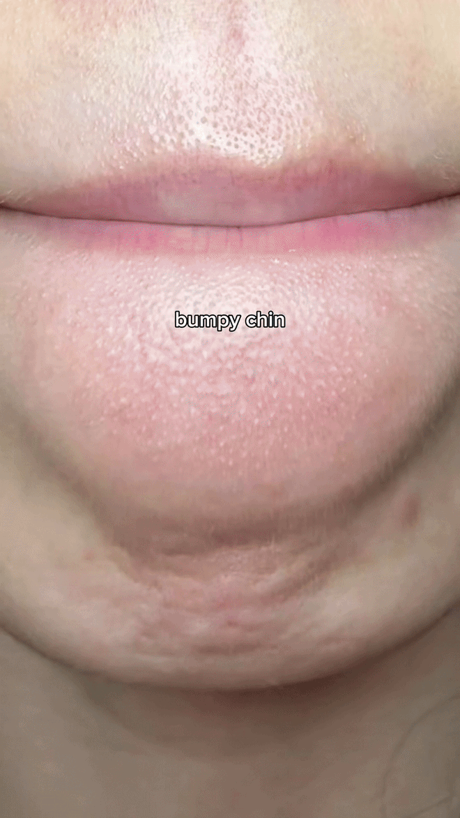 Nhiều người bôi “thạch đỏ” lên da, đến lúc nhìn lại lỗ chân lông mà giật mình- Ảnh 7. Nhiều người bôi “thạch đỏ” lên da, đến lúc nhìn lại lỗ chân lông mà giật mình- Ảnh 7.