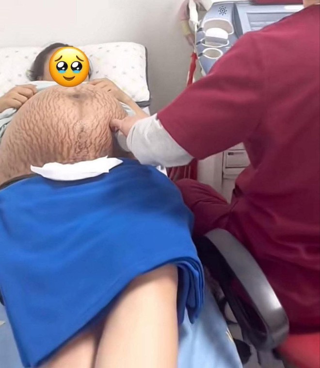 Xót xa hình ảnh chiếc bụng rạn nứt chằng chịt như dưa bở của mẹ bầu thai đôi ở tuần thứ 36- Ảnh 1.