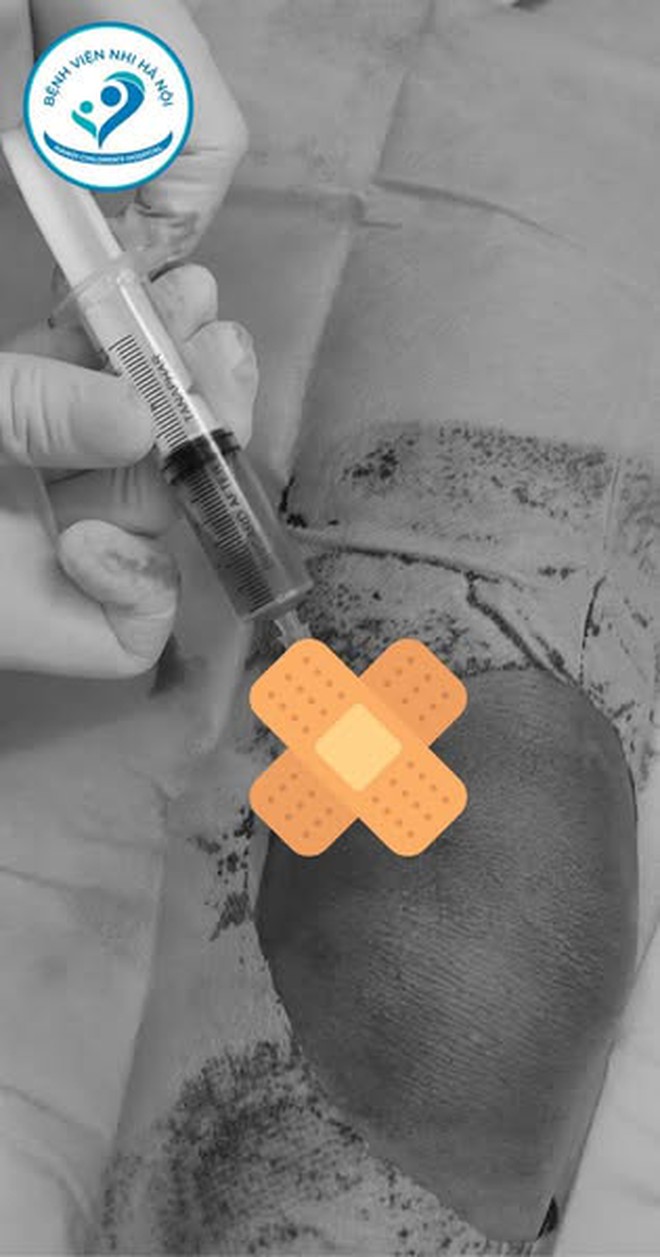 Bé 6 tuổi bị viêm mủ khớp gối và viêm xương tủy sau va đập: BS cảnh báo chấn thương kín của trẻ có thể tiềm ẩn nhiều nguy cơ hơn bố mẹ nghĩ- Ảnh 2. Bé 6 tuổi bị viêm mủ khớp gối và viêm xương tủy sau va đập: BS cảnh báo chấn thương kín của trẻ có thể tiềm ẩn nhiều nguy cơ hơn bố mẹ nghĩ- Ảnh 2.