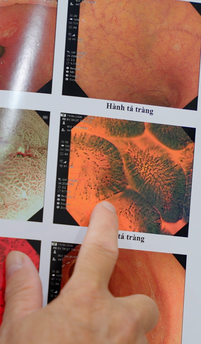 V&igrave; sao c&ugrave;ng l&agrave; kết quả "b&igrave;nh thường" nhưng nội soi đường ti&ecirc;u h&oacute;a bằng m&aacute;y ph&oacute;ng đại 520 lần đ&aacute;ng tin cậy hơn 135 lần?- Ảnh 3.