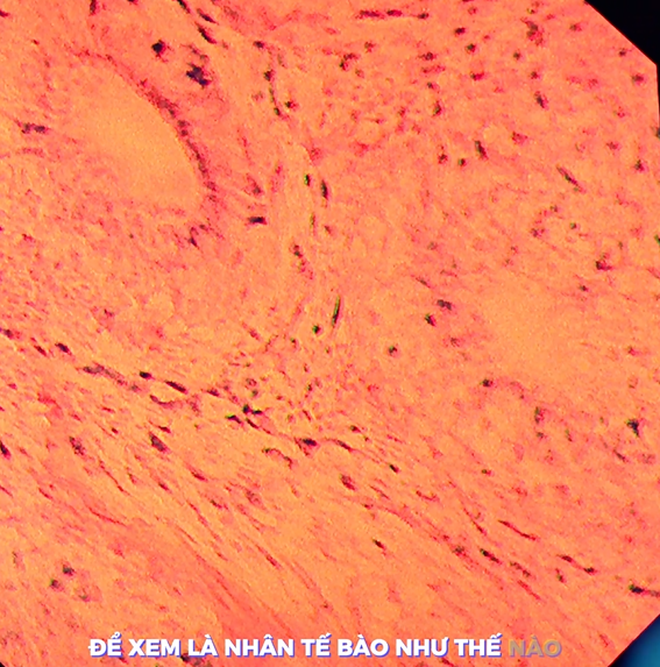 V&igrave; sao c&ugrave;ng l&agrave; kết quả "b&igrave;nh thường" nhưng nội soi đường ti&ecirc;u h&oacute;a bằng m&aacute;y ph&oacute;ng đại 520 lần đ&aacute;ng tin cậy hơn 135 lần?- Ảnh 5.