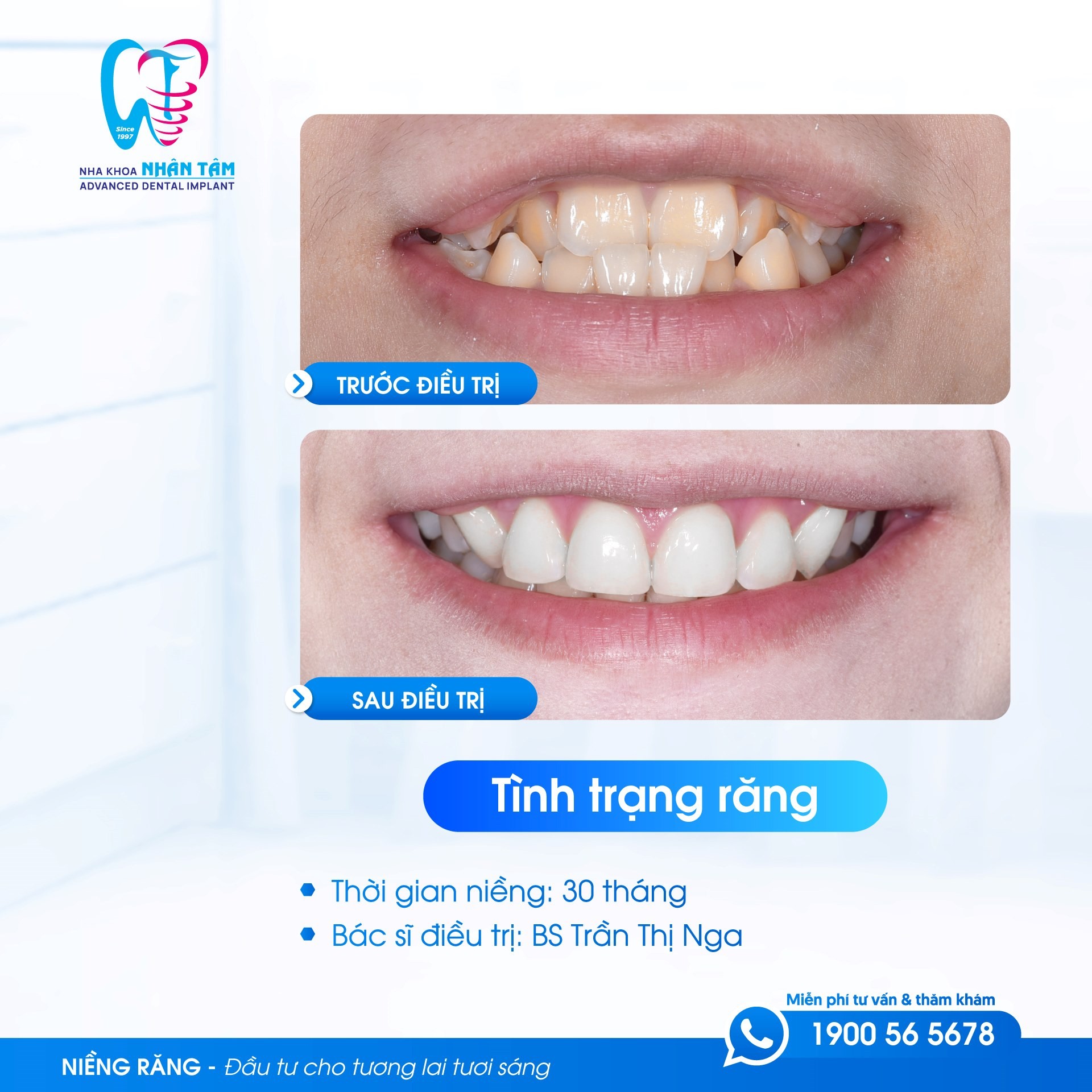 Niềng răng c&oacute; đau kh&ocirc;ng? Địa chỉ niềng răng uy t&iacute;n gi&uacute;p bạn 'lột x&aacute;c' nụ cười - Ảnh 3.