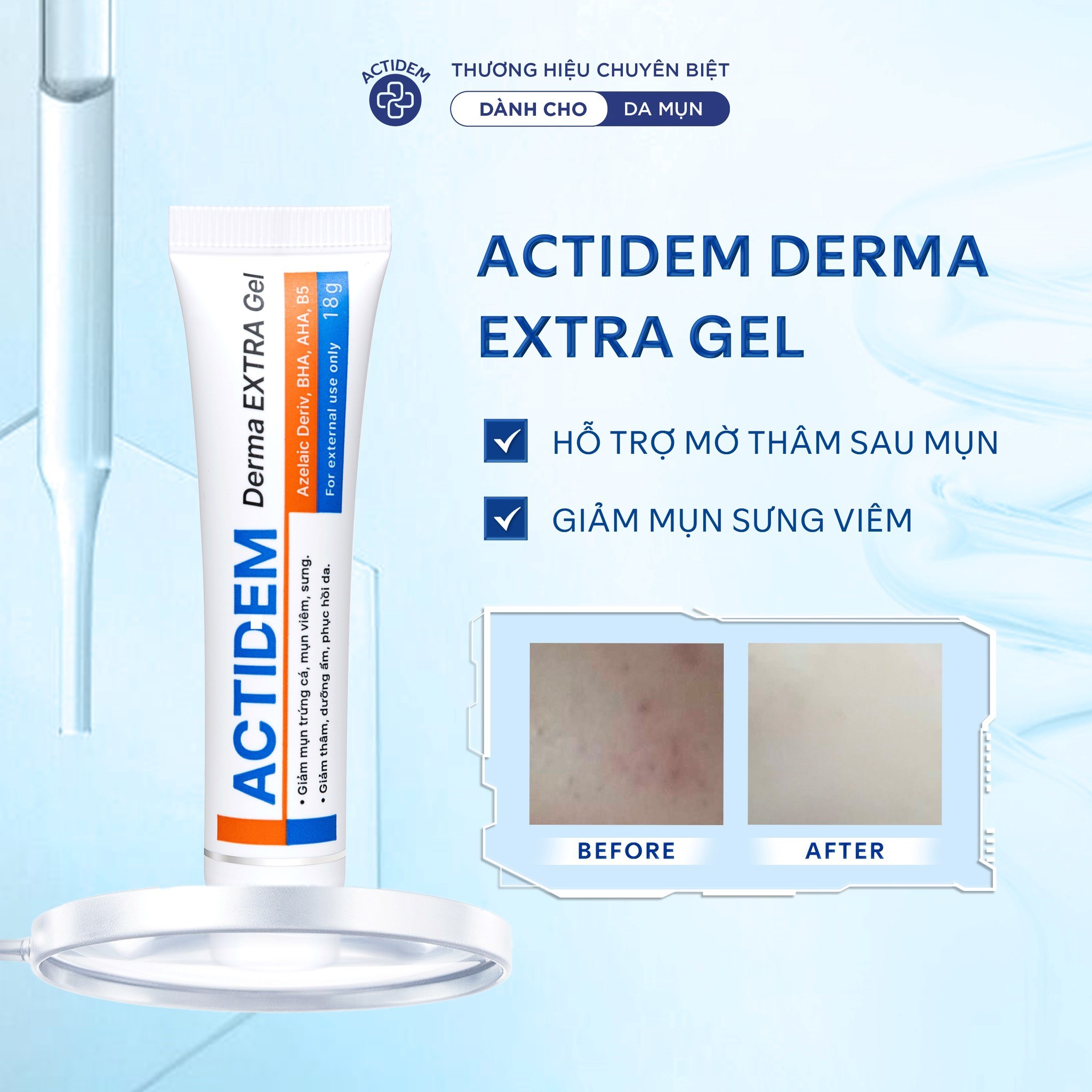 Bộ đ&ocirc;i Actidem Derma Gel v&agrave; Actidem Derma Extra Gel: 'Dọn mụn' chuẩn chuy&ecirc;n gia cho từng cấp độ - Ảnh 3.