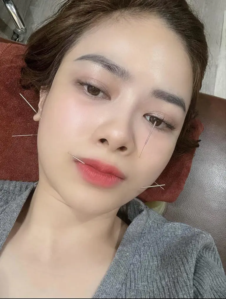 Dương Hoàng Yến hồi phục sau một tháng điều trị liệt dây thần kinh số 7- Ảnh 1. Dương Hoàng Yến chia sẻ ảnh châm cứu và nhập viện điều trị liệt dây thần kinh số 7.