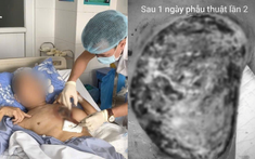 Người đàn ông bị hoại tử mô cơ vùng ngực trái sau buổi dọn nghĩa trang cuối năm