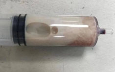 Thanh niên nhập viện sau bữa lẩu nướng, bác sĩ rút ra thứ chất lỏng khiến ai cũng rùng mình