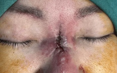 Người phụ nữ bị “ăn thủng mũi” sau khi làm đẹp đổi vận