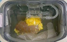 Tin vui cho người suy thận, cần ghép thận