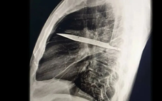 Người đàn ông mang "thứ này" trong lồng ngực suốt 8 năm mà không hề hay biết