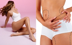Hút mỡ Vaser Lipo: Giải pháp không phẫu thuật nhưng vẫn cần thận trọng