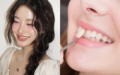 Cách chăm sóc răng sau khi làm veneer: Bí quyết giữ nụ cười trắng sáng lâu dài